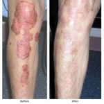 AROGYAM-PURE-HERBS_br_-KIT-FOR-PSORIASIS-228×228